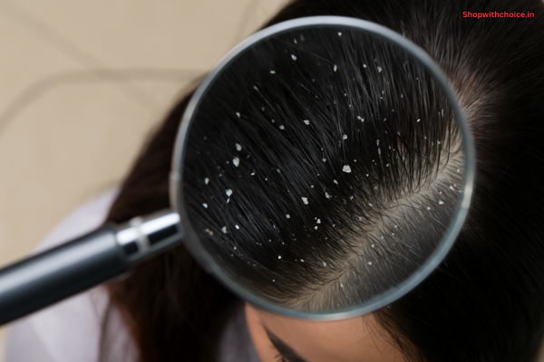 What Is Dandruff? Causes, Symptoms and Effective Treatment Explained