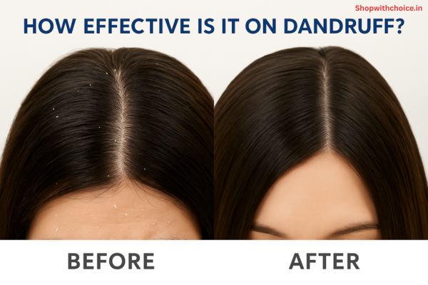Selsun Blue Anti-Dandruff Shampoo Review: Does It Really Work for Severe Dandruff?